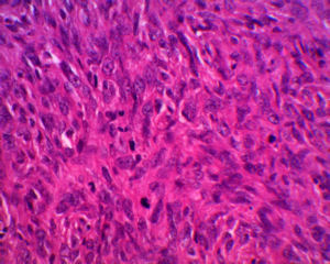 軟部組織肉腫グレード3強拡